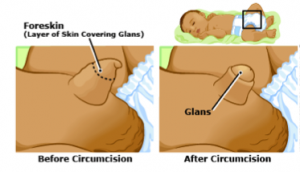 Circumcision on Infant